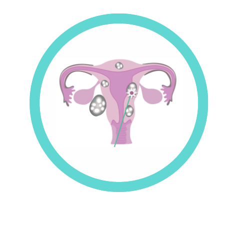 Útero con miomas sin fondo, tamaño 500 x 500